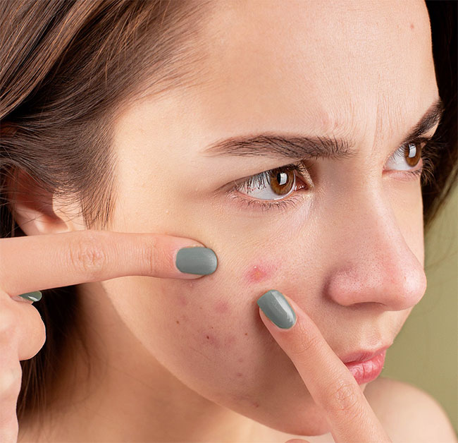 Pimple Popping - The Good, the Bad, and the Ugly Truth 