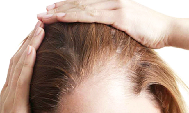 Things that Make Females Vulnerable to Hair Loss